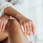 Comment traiter le psoriasis naturellement grâce à la naturopathie - Naturopathe mantes la jolie - Loup la Vie